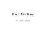 How to Treat Burns - slide 1
