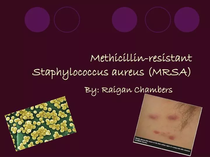 methicillin resistant staphylococcus aureus mrsa