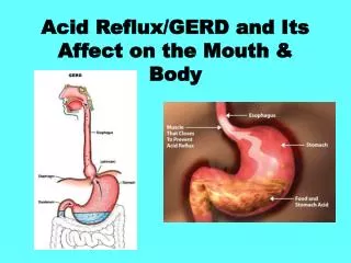 Acid Reflux/GERD and Its Affect on the Mouth &amp; Body