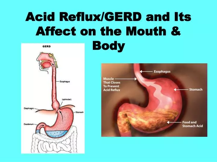 Snacks for Acid Reflux -