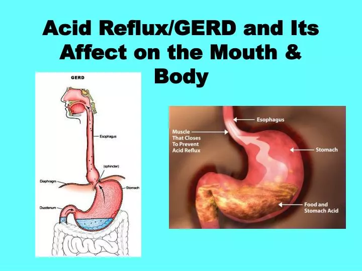 acid reflux gerd and its affect on the mouth body