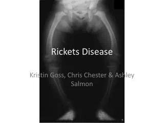 Rickets Disease