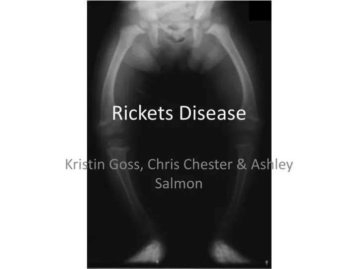 rickets disease