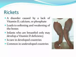 rickets