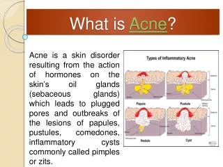 Acne No More Review - Is It Worth Your Time & Money?