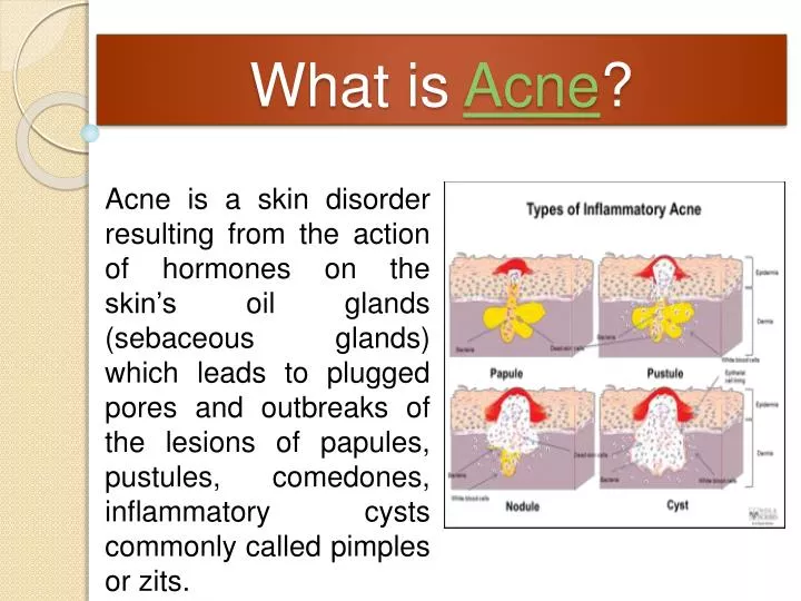 what is acne