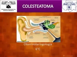 colesteatoma