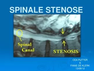 spinale stenose