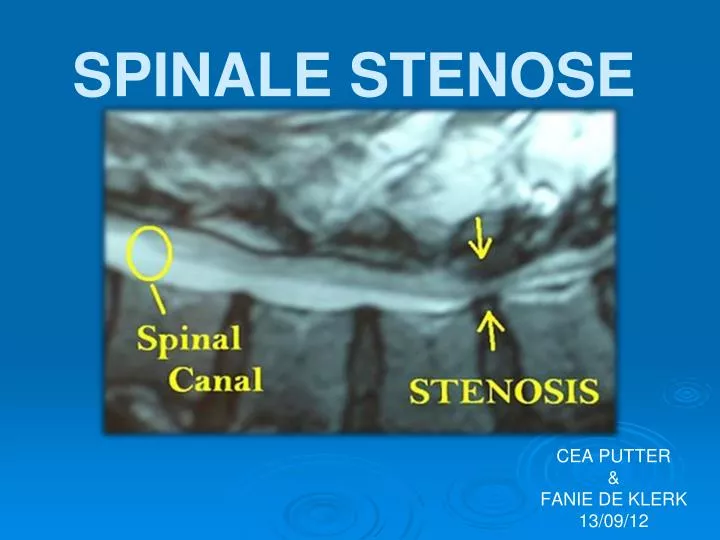 spinale stenose