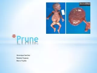 Prune Prune belly syndrome