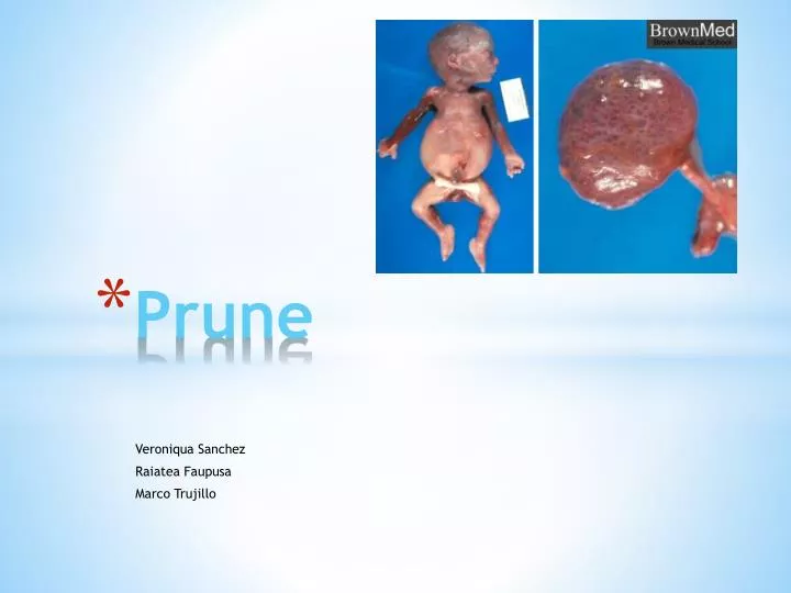 prune prune belly syndrome