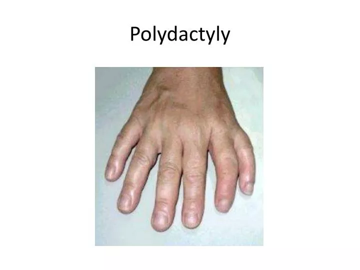 polydactyly