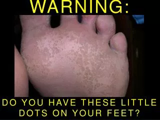 WARNING: DO YOU HAVE THESE LITTLE DOTS ON YOUR FEET?