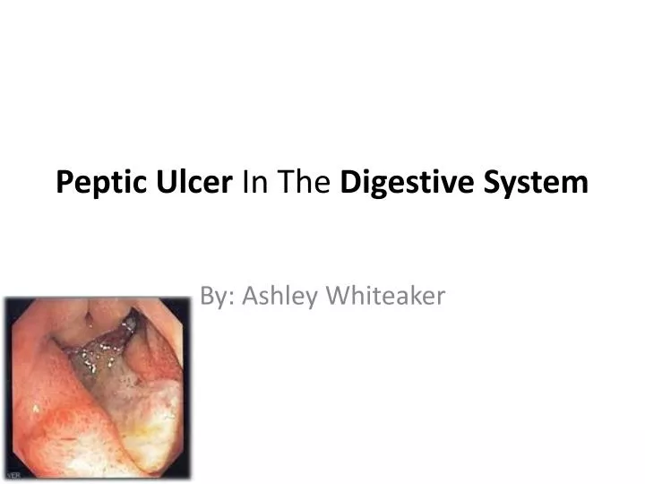 peptic ulcer in t he digestive s ystem