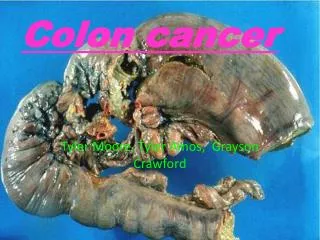 Colon cancer