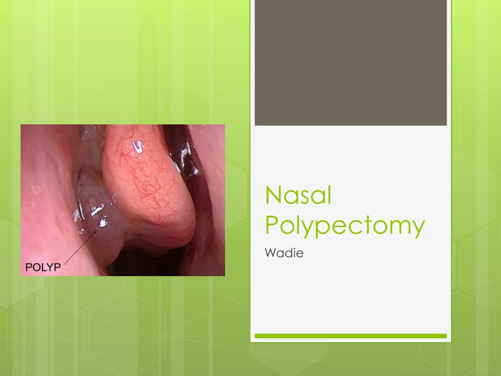 Polypectomy Definition PPT - Nasal Polypectomy PowerPoint Presentation, free download - ID:2634487