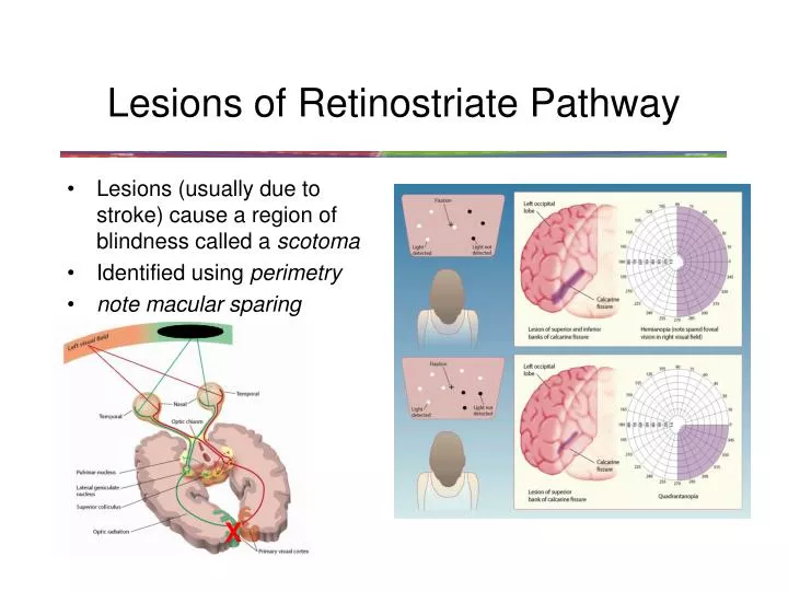 lesions of retinostriate pathway