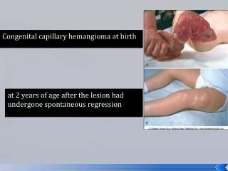 Congenital capillary hemangioma at birth