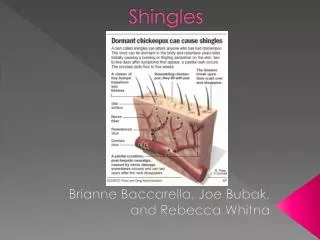 Shingles