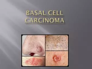 basal cell carcinoma