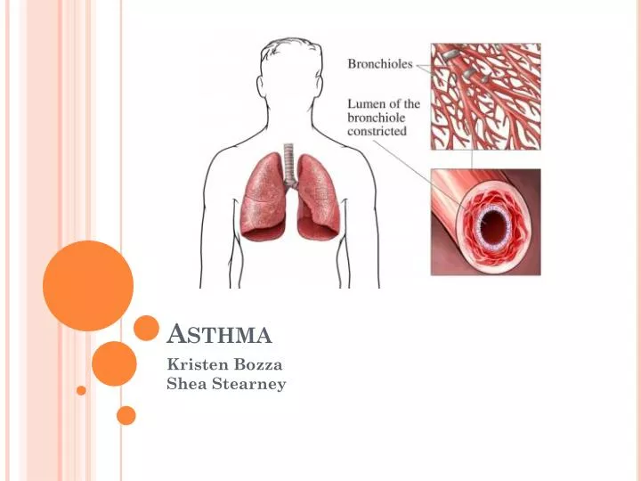 asthma