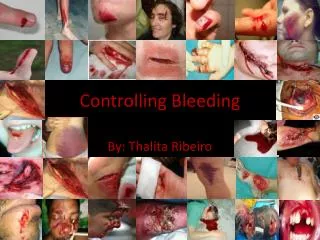 Controlling Bleeding