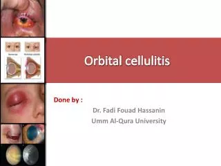 Orbital cellulitis