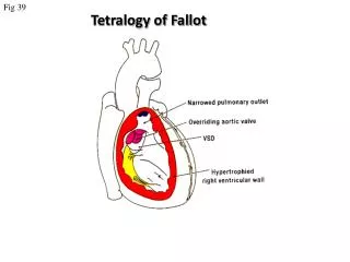 Tetralogy of Fallot