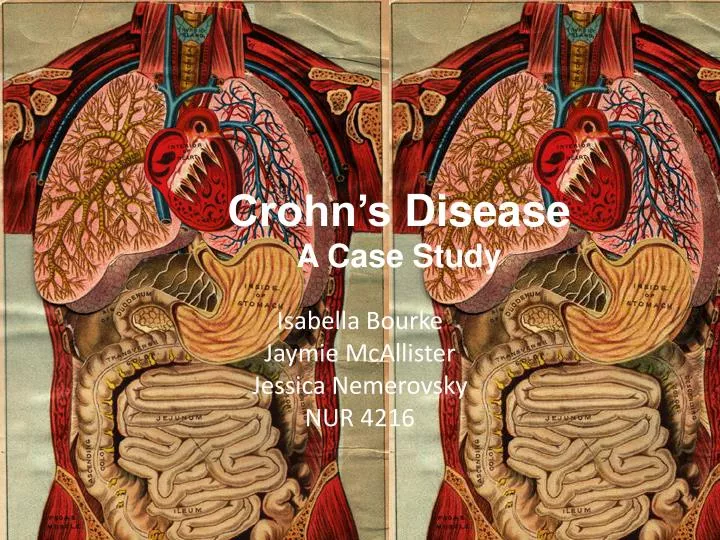 case study 21 crohn's disease