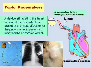 Topic: Pacemakers