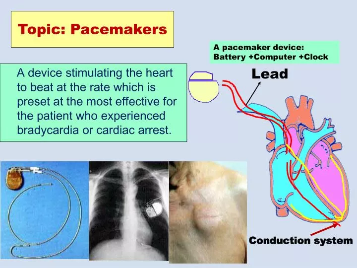 topic pacemakers