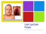 Cleft Lip/Cleft Palate