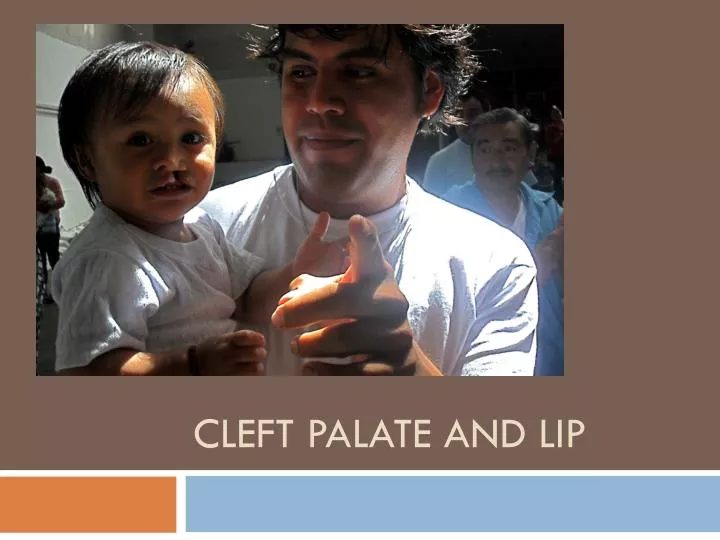 cleft palate and lip
