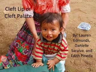 Cleft Lip or Cleft Palate