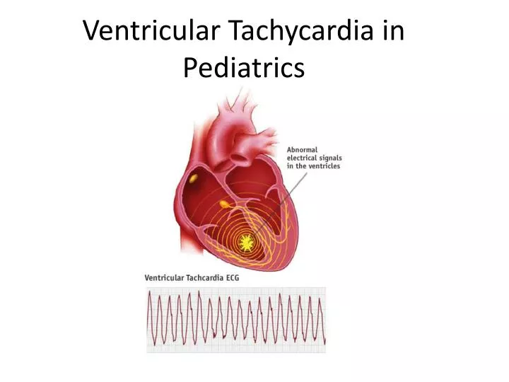 ventricular tachycardia in pediatrics