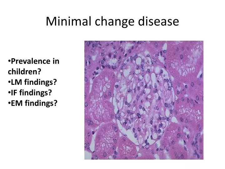 minimal change disease