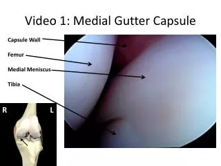 Video 1: Medial Gutter Capsule