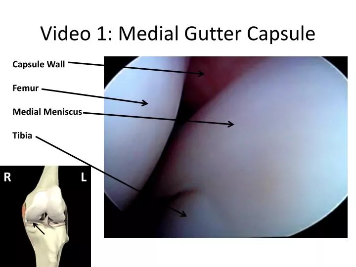 video 1 medial gutter capsule