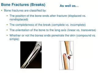 Bone Fractures (Breaks)