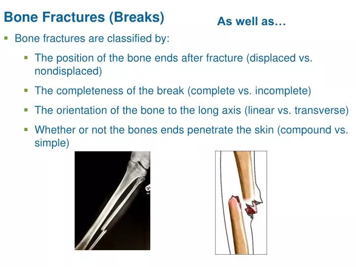 bone fractures breaks