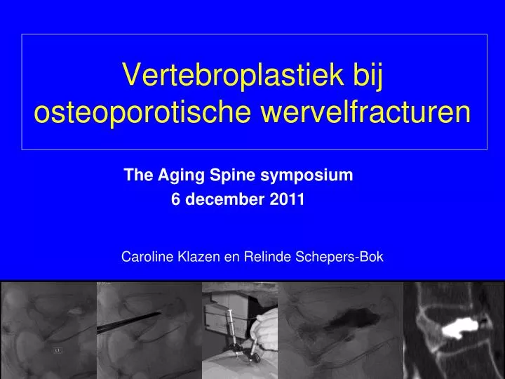 vertebroplastiek bij osteoporotische wervelfracturen