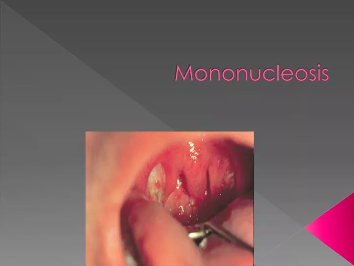 mononucleosis