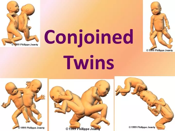 conjoined twins