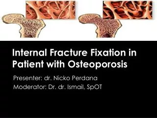 Internal Fracture Fixation in Patient with Osteoporosis