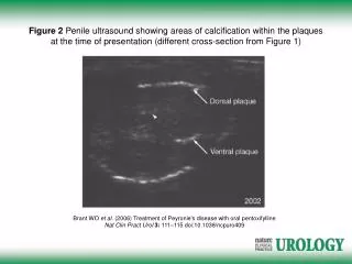 Brant WO et al. (2006) Treatment of Peyronie's disease with oral pentoxifylline