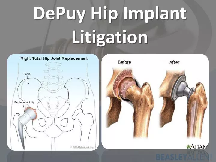 depuy hip implant litigation