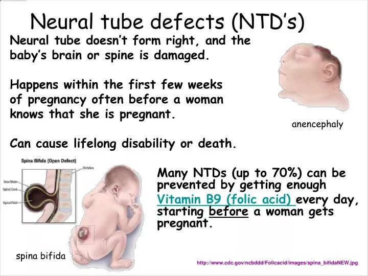 neural tube defects ntd s