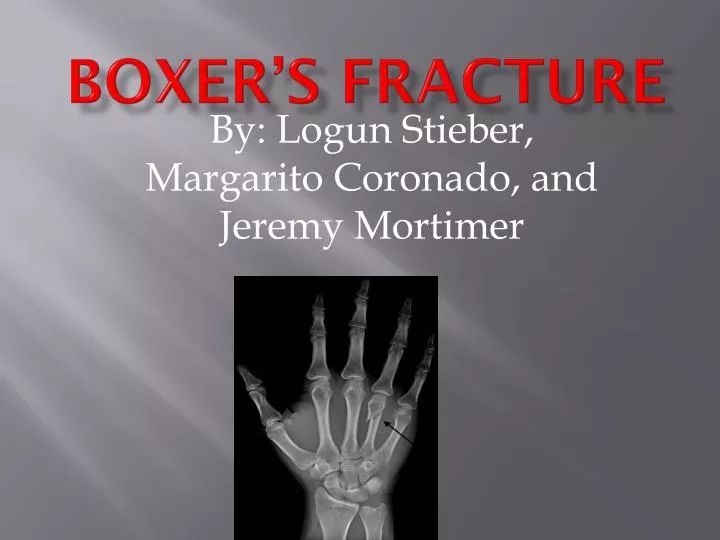boxer s fracture