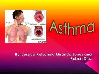 Asthma