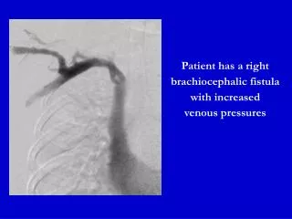 Patient has a right brachiocephalic fistula with increased venous pressures